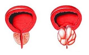 Prostate dans un état normal (à gauche) et enflammée par une prostatite (à droite)